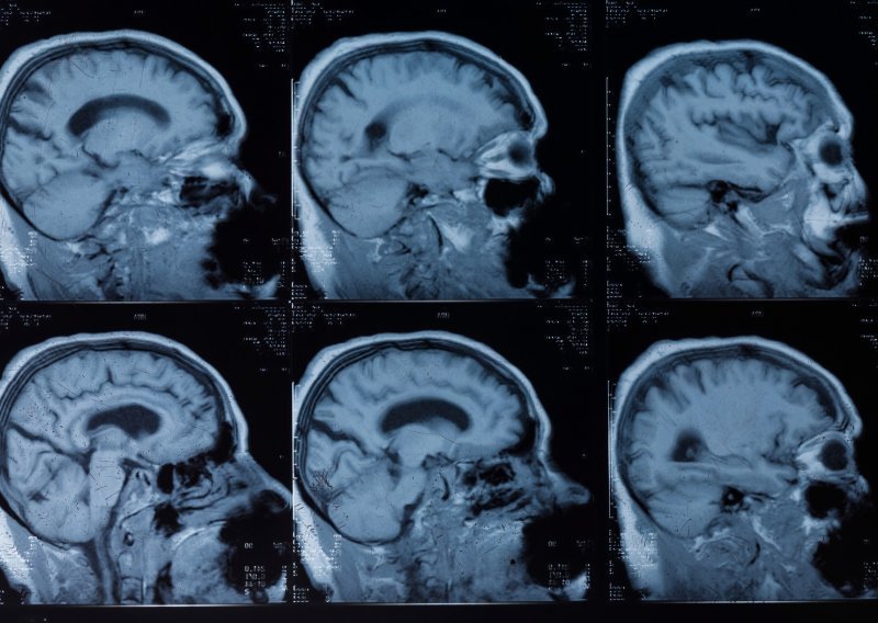Znanstvenici otkrili područja koja u mozgu oštećuje krvni tlak i kakve to veze ima s demencijom