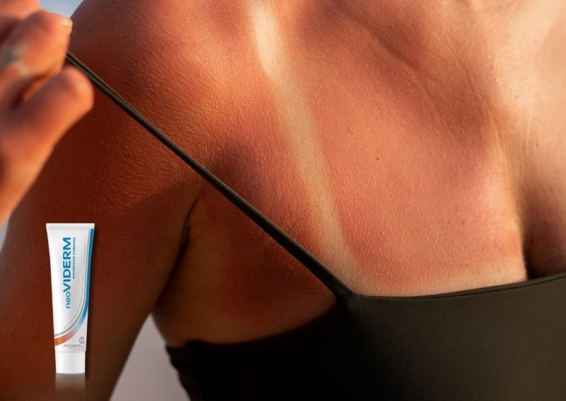 Opekline od sunca – što ako ih unatoč SPF-u zadobijete?