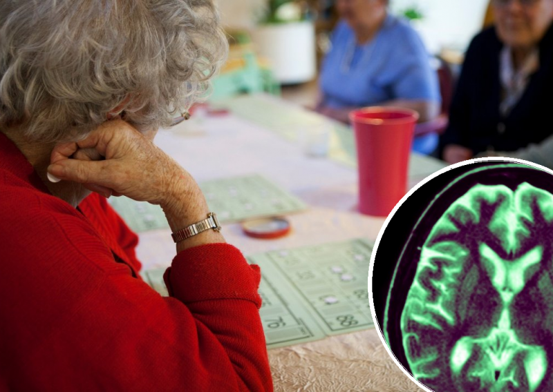 Donanemab je prekretnica u borbi protiv Alzheimerove bolesti. No postoje i rizici