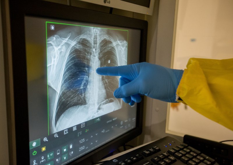 Nada za plućne bolesnike: Liječenje moguće transplantacijom vlastitih stanica?