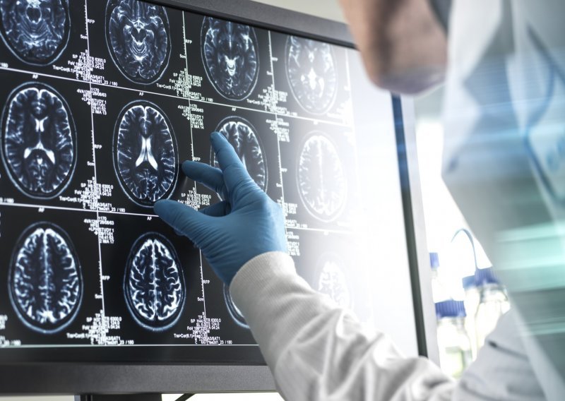 Revolucija u medicini: Znanstvenici napravili najveću mapu mozga ikad