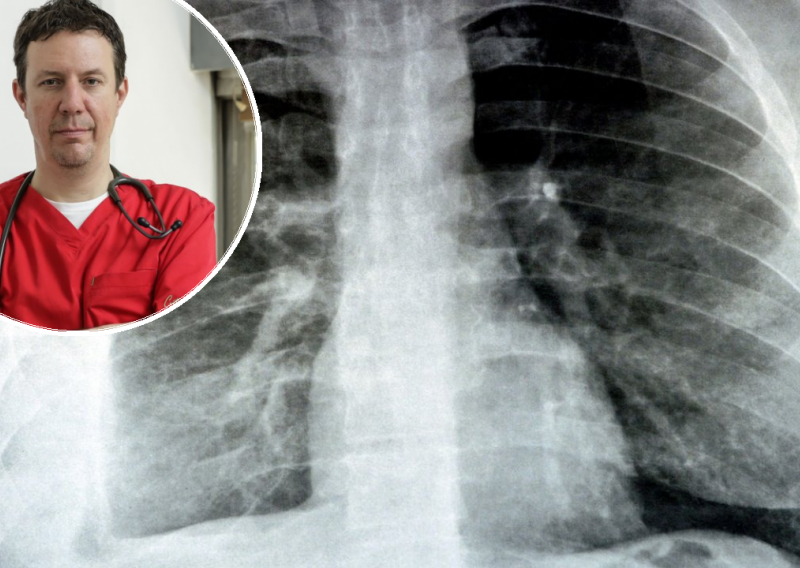 Kako prepoznati tzv. hodajuću upalu pluća i kada se javiti liječniku