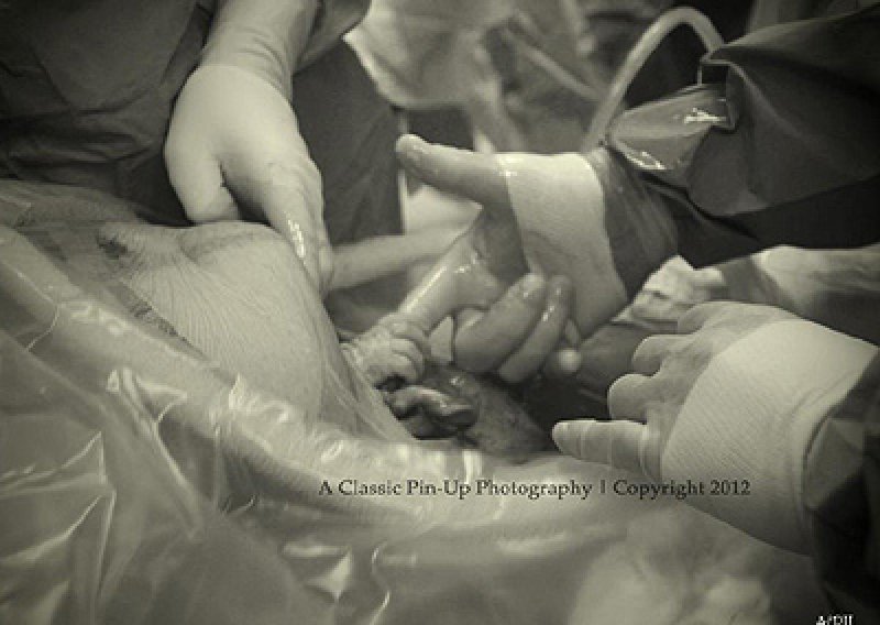Beba snimljena kako hvata kirurga za prst tijekom carskog reza