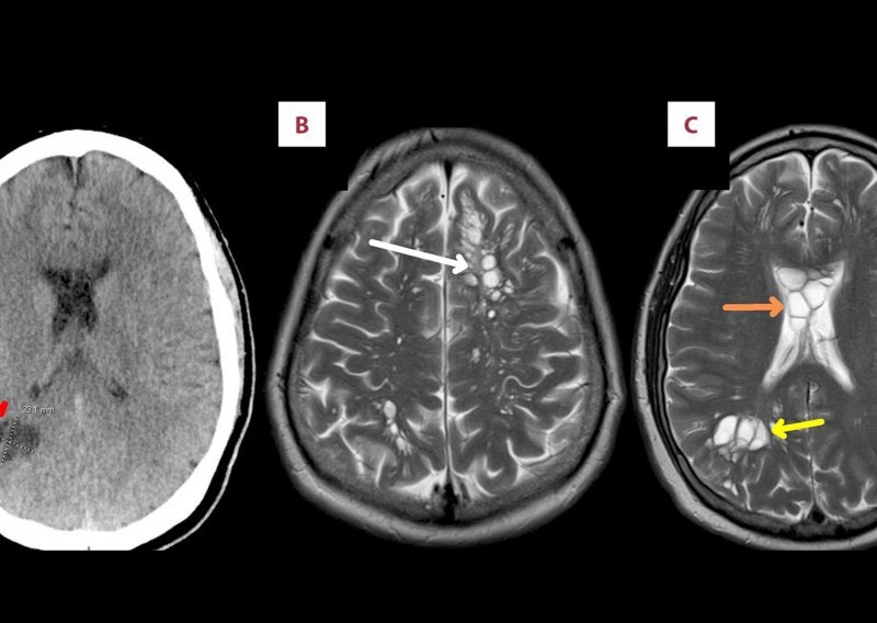 Čovjek pogrešno pripremao slaninu pa dobio trakavicu u mozgu: Počelo je migrenom
