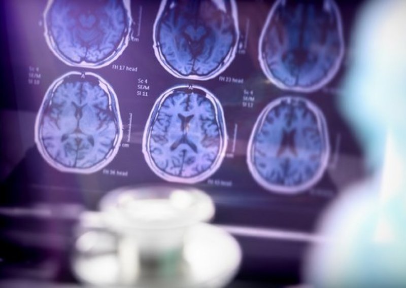 Neurolog o novom lijeku protiv Alzheimera: 'Treba ga učiniti što prije dostupnim'