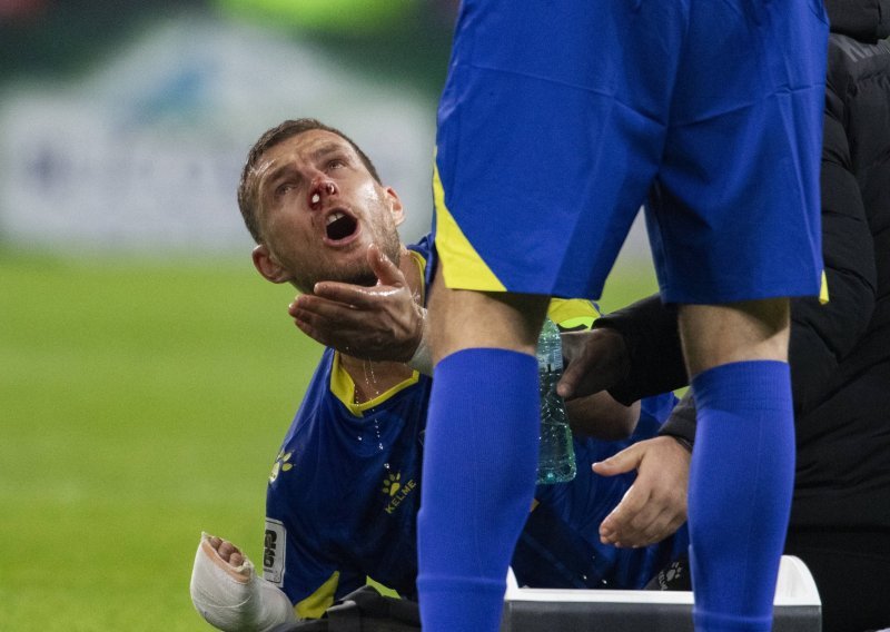 Edin Džeko objavio kako mu izgleda lice nakon brutalnog udarca kopačkom u glavu