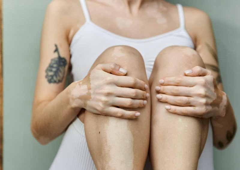 S ovom kožnom bolesti u Hrvatskoj živi više od 45.000 ljudi
