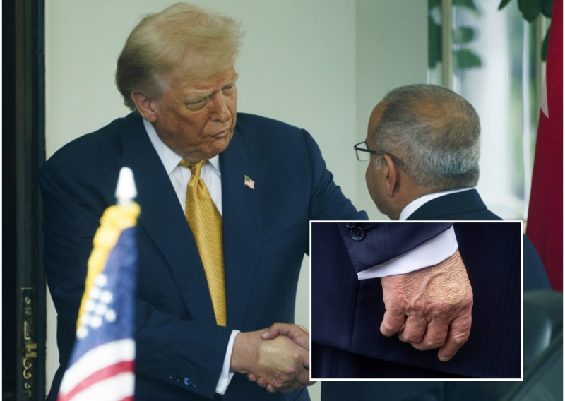 Trumpova ruka otkrila da ima ozbiljnu kroničnu bolest: Ovi simptomi su znak alarma