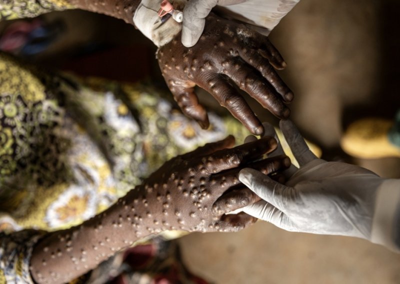 Kongo: Problemi sa skladištenjem doveli do propadanja cjepiva protiv mpoxa