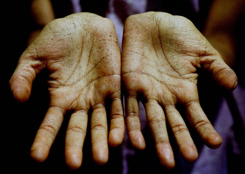 U Hrvatskoj potvrđen slučaj gube!