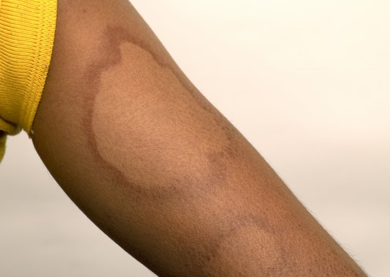 Udruga pacijenata ogorčena šutnjom o slučaju gube: Ovako nešto ne smije se zataškavati