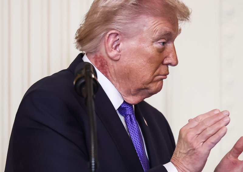 Svi se pitaju: Misteriozni osip na Trumpovom vratu pokrenuo val nagađanja