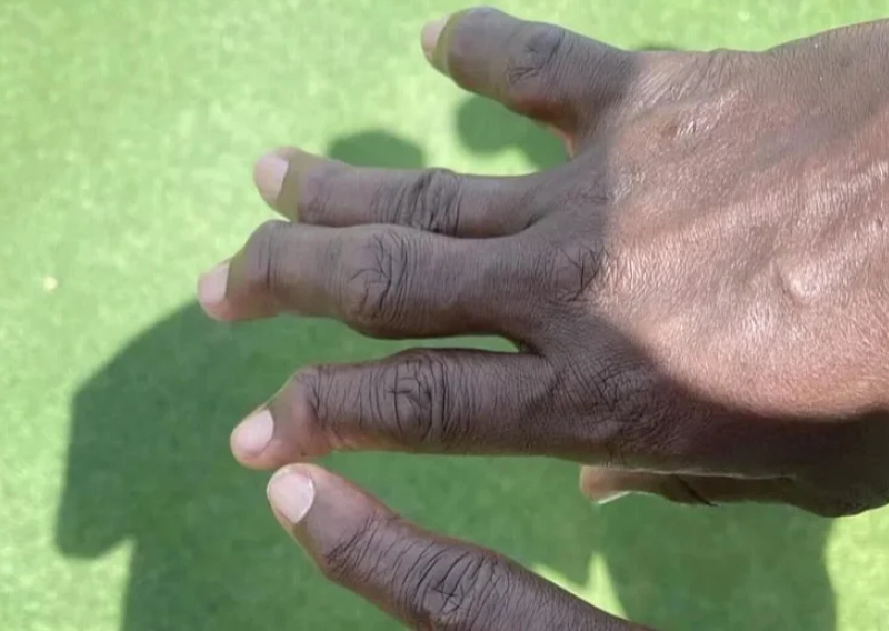 Šokantne posljedice: Ovako izgledaju prsti igrača američkog nogometa