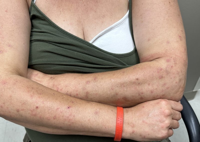 Srbi u panici: Šuga se širi zemljom, zaraza kola školama, vrtićima i tvornicama