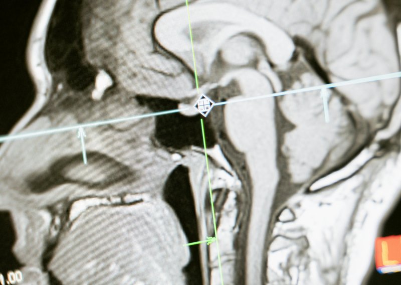 Kina odobrila komercijalnu primjenu čipova za mozak: Osobe s paralizom pokretat će ruke mislima