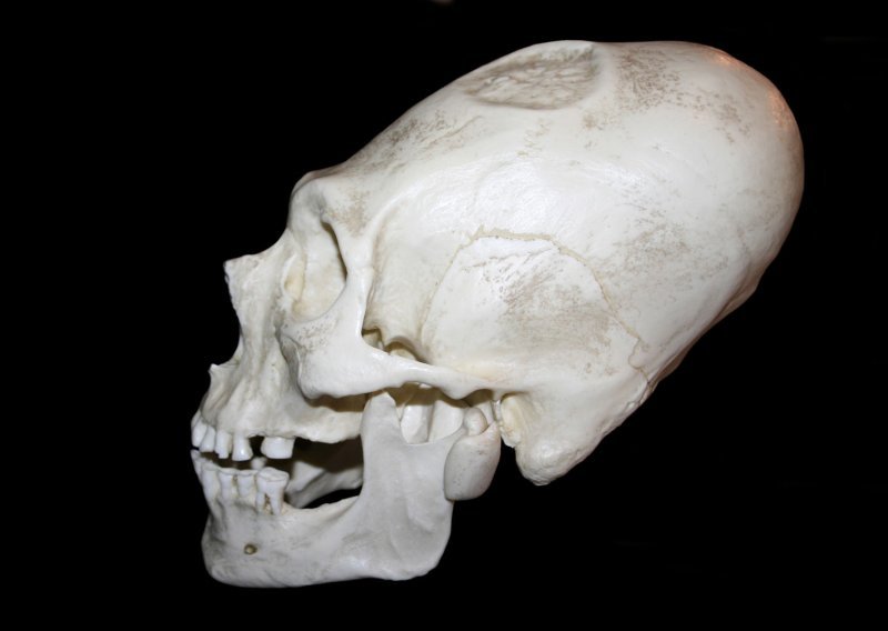 Izduživanje lubanja: Što se krije iza jednog od najbizarnijih običaja u povijesti?