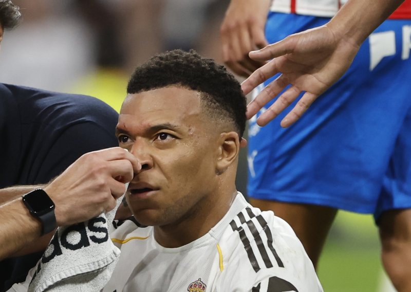 Mbappe objavio fotografiju glave: Pogledajte ozljedu za koju nije dobio penal