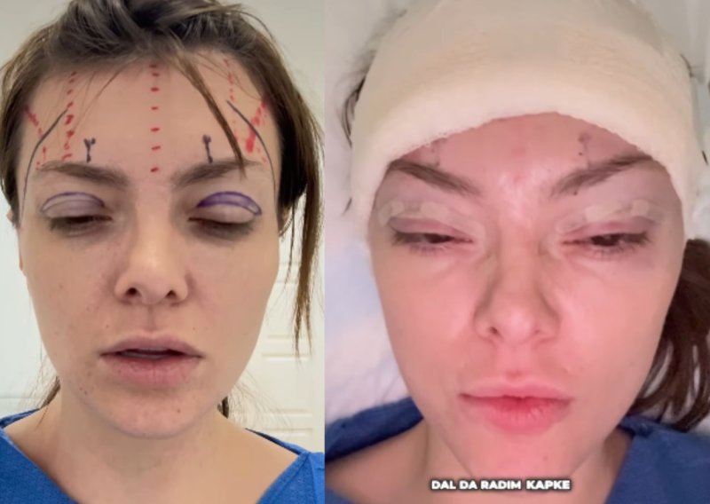 Prizor kojem se niste nadali: Ella Dvornik na društvenim mrežama otkrila da je 'otišla pod nož'