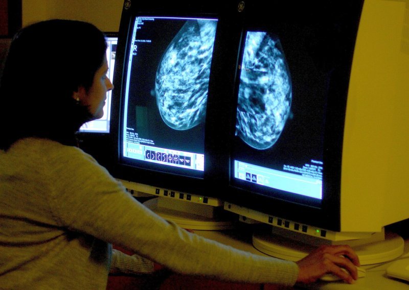 Važan iskorak: Znanstvenici došli do velikog otkrića u liječenju raka dojke