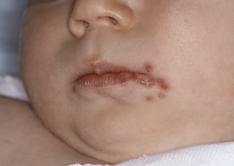 Sve više slučajeva impetiga, no stručnjaci smiruju: Nema razloga za paniku