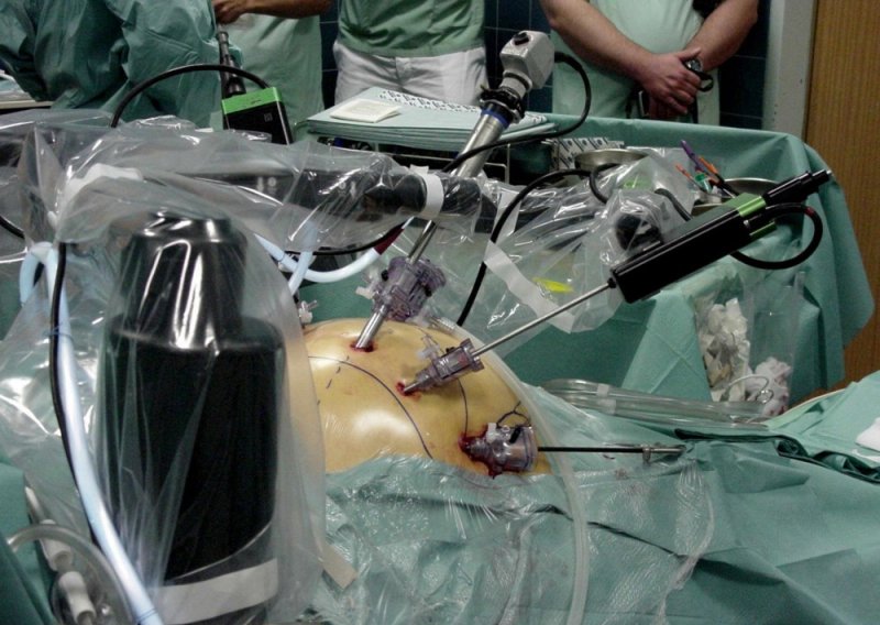 AI pomogao kirurzima ukloniti tumor na mozgu
