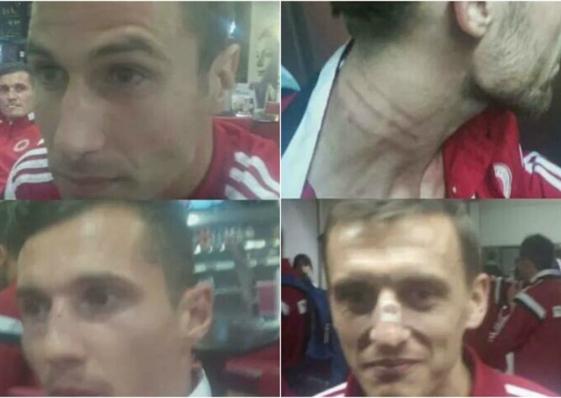 Dočekani kao heroji: Albanski igrači pokazali svoje ozljede!