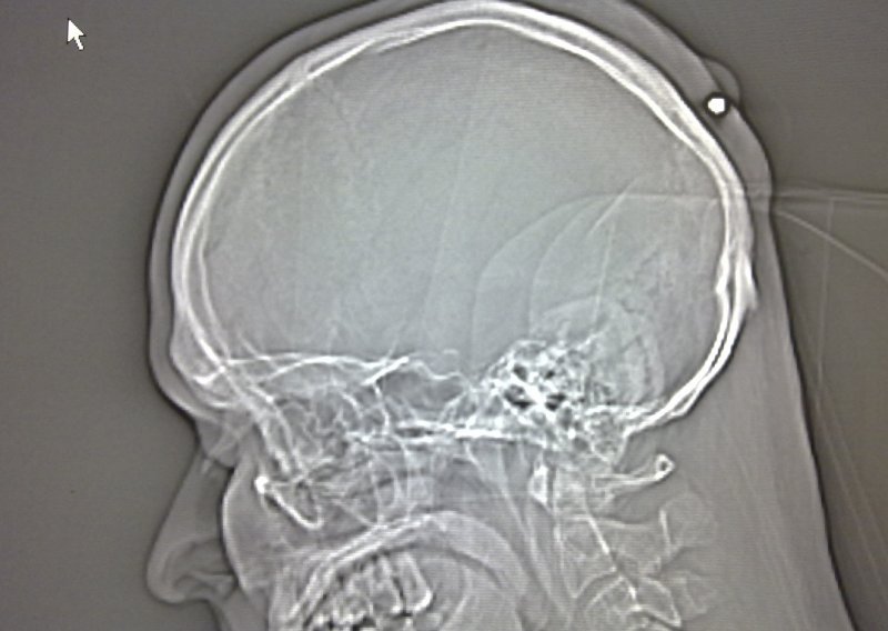 Čovjek otkrio metak u glavi nakon pet godina