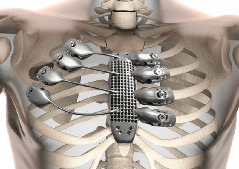 3D printana rebra od titana pravo su čudo