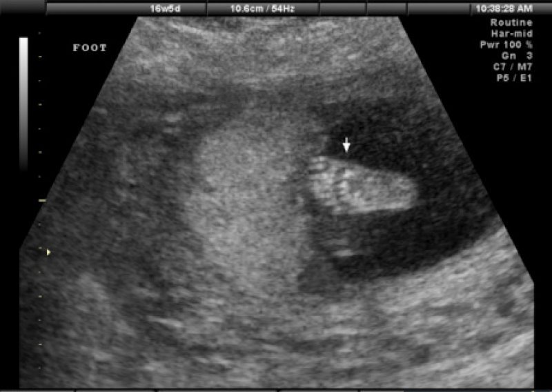 Majke će prije abortusa slušati kucanje srca fetusa