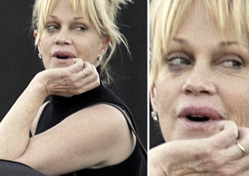 Melanie Griffith ima rak kože