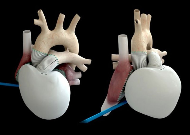 Umro prvi pacijent s umjetnim srcem