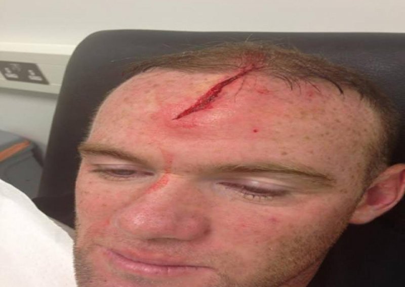 Jako ružna ozljeda glave Waynea Rooneyja!