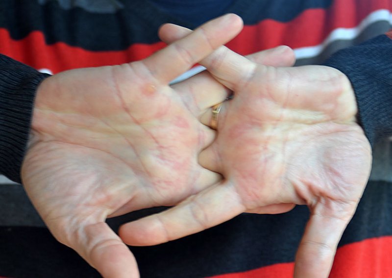Je li pucanje prstima štetno za zdravlje?