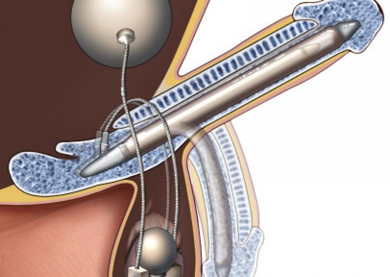 Završio u bolnici nakon osam dana erekcije