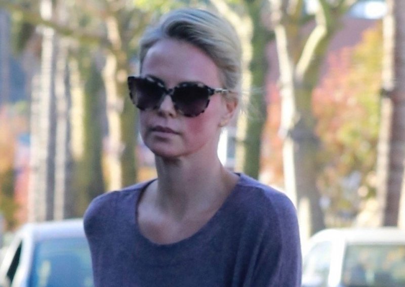 Što se dogodilo s licem Charlize Theron: Kozmetički tretman, alergija...?