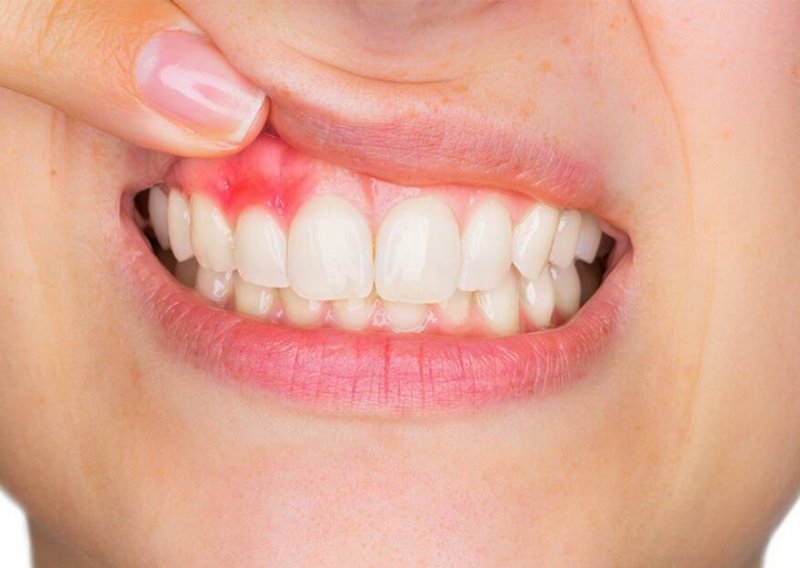 Bolest desni – patite li od parodontoze?