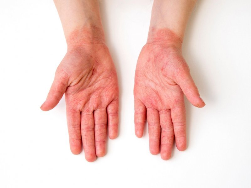Svrbež kože bez osipa – uzroci, simptomi i liječenje
