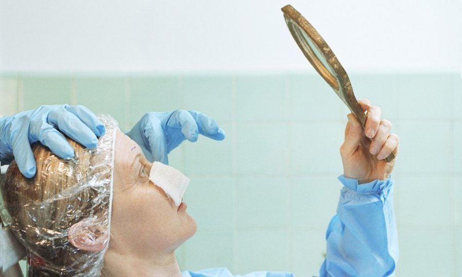 žena poslije kozmetičke kirurgije rinoplastika