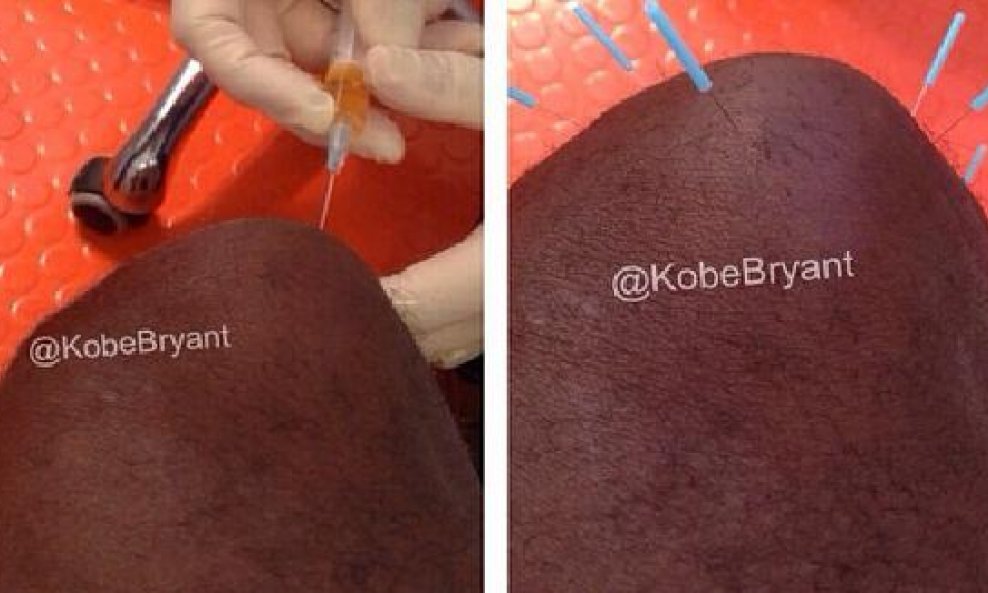 Kobe Bryant koljeno akupunktura