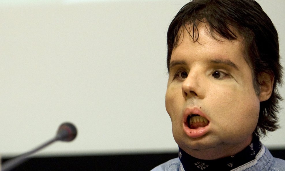 oscar španjolac transplantirano lice