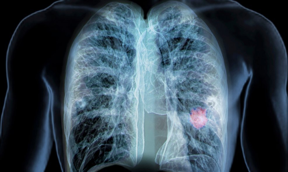 Rak pluća - ilustracija