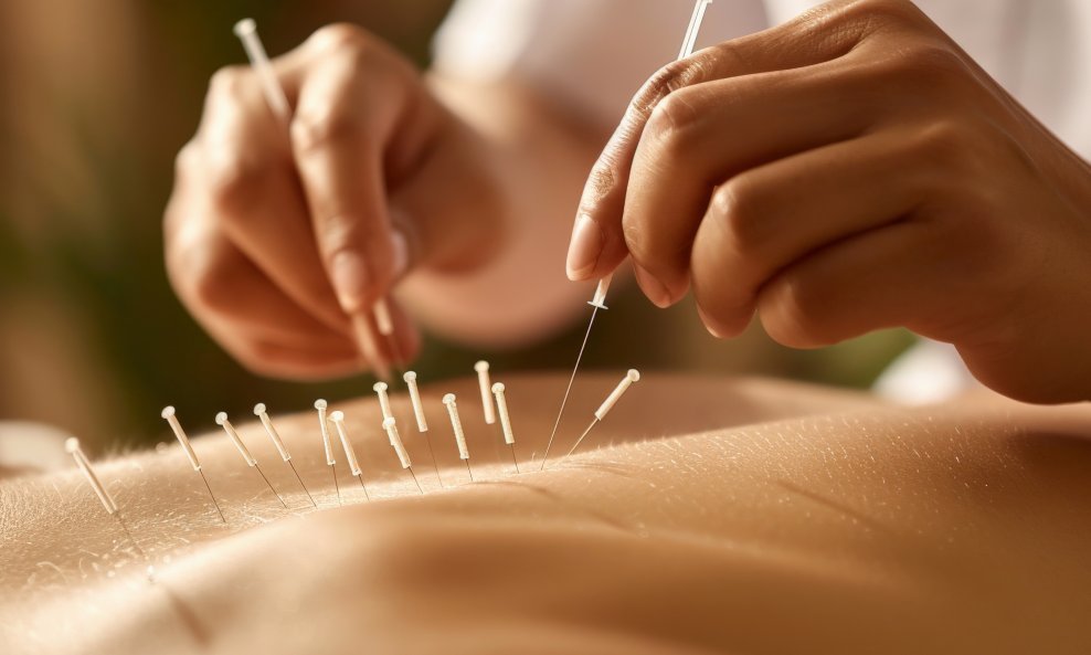 akupunktura