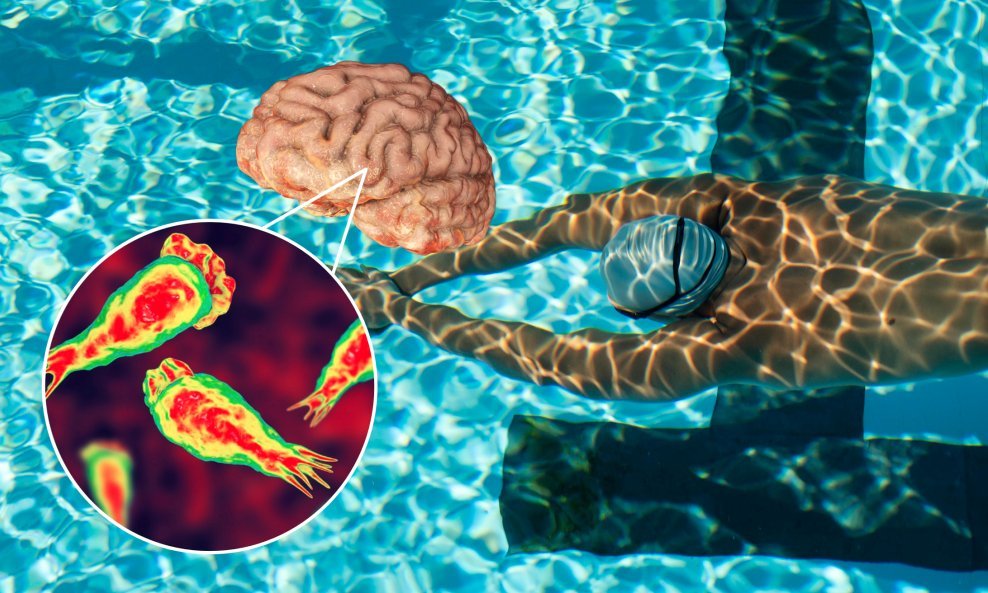 Infekcija amebom koja jede mozak