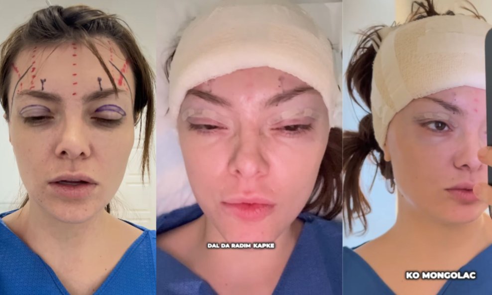 Ella Dvornik nakon zahvata