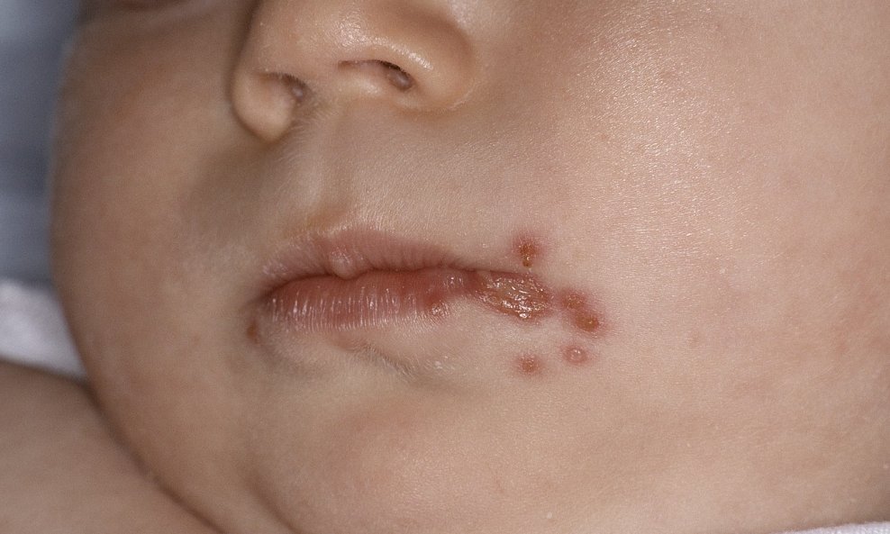 Impetigo