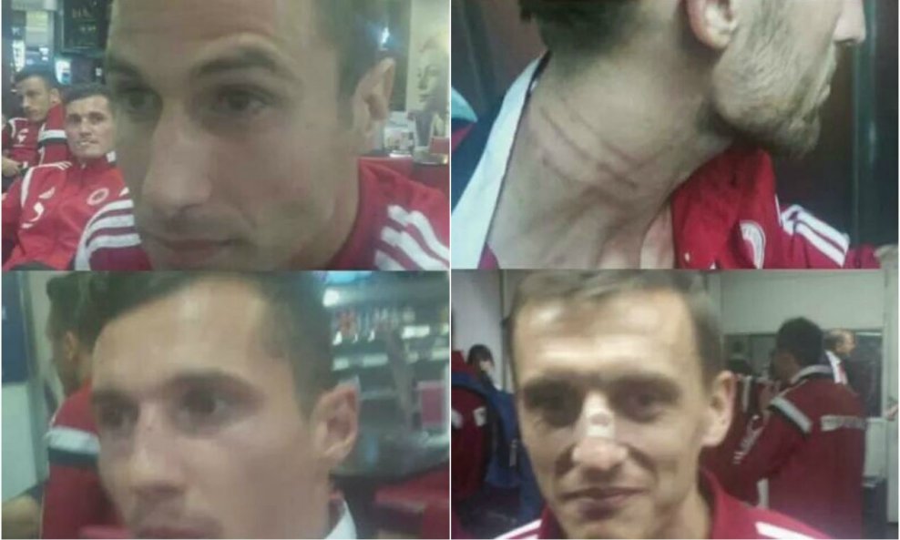 Ozljede albanskih nogometaša