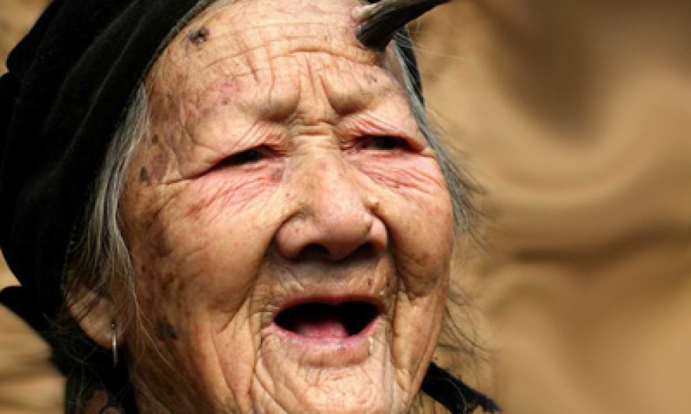 starica Zhang Ruifang rog izraslina čelo