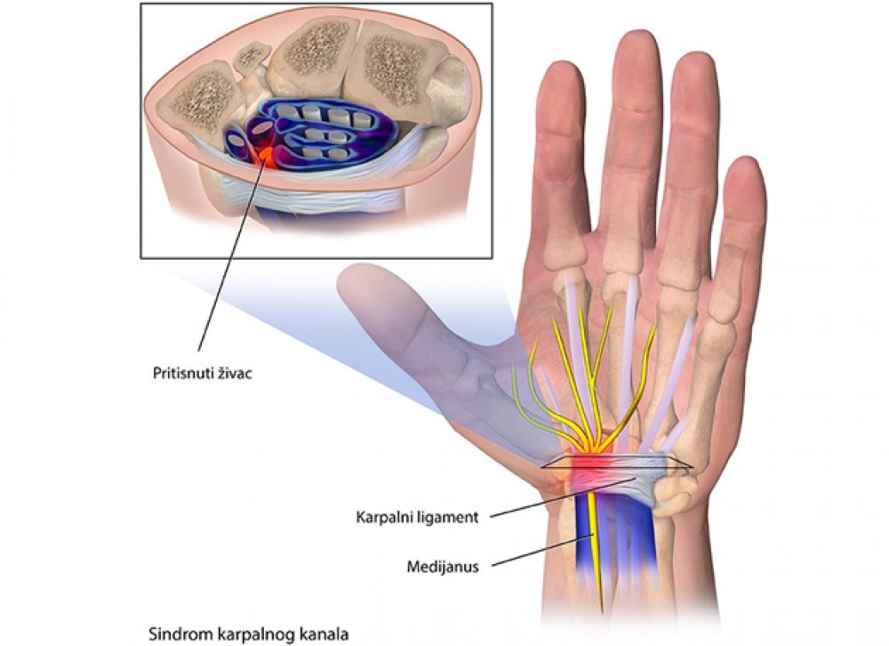 karpalna bol nego liječiti
