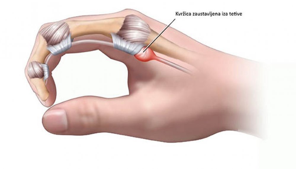 bolovi u zglobu srednjeg prsta na ruci