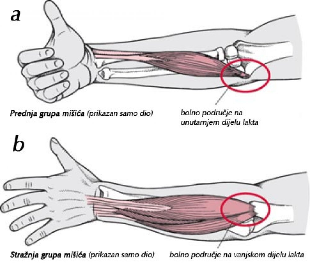 bol u laktu stisnuta šaka zajedničke vježbe protiv bolova